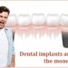 Dental Implants are worth the money spent
