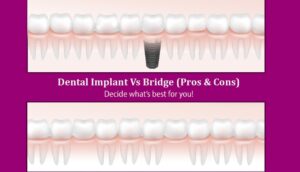 Dental Implants Vs Dental Bridges