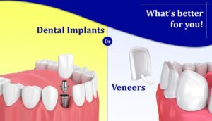 Dental Implants or Veneers – Exploring The Pros and Cons - perfect