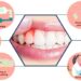 Gum Disease Symptoms, Treatment, and Prevention
