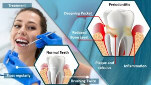 Periodontitis disease symptoms