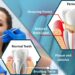 Periodontitis disease symptoms