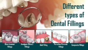 Types of Dental Fillings