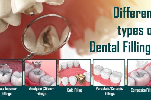 Types of Dental Fillings