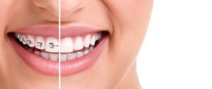 Invisalign as an Aspiring Model - Invisalign vs braces