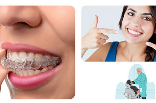 An Introduction To Invisalign In 5 Minutes- Invisalign -Invisalign orthodontist