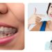 An Introduction To Invisalign In 5 Minutes- Invisalign -Invisalign orthodontist