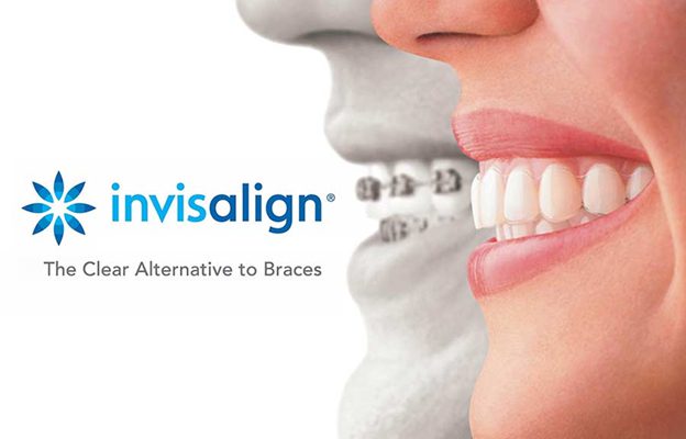 Braces Orthodontic Treatment