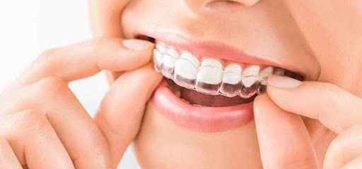 Tooth Braces