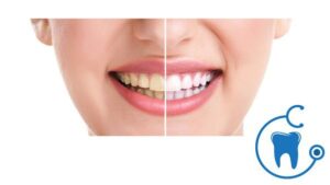 Teeth Whitening - Tooth Whitening Treatment