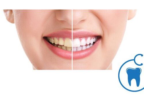 Teeth Whitening - Tooth Whitening Treatment