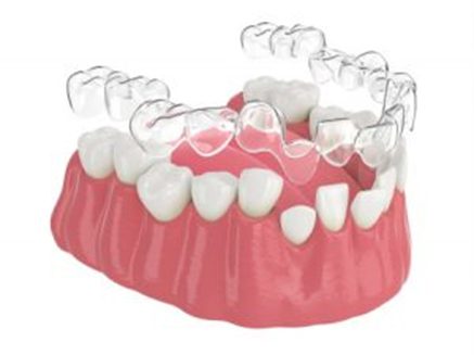 Invisalign Cost Australia - Invisalign dentist near me