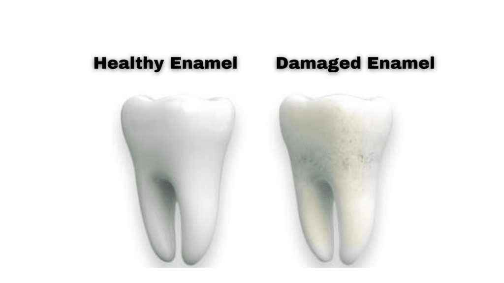 What is Enamel Erosion