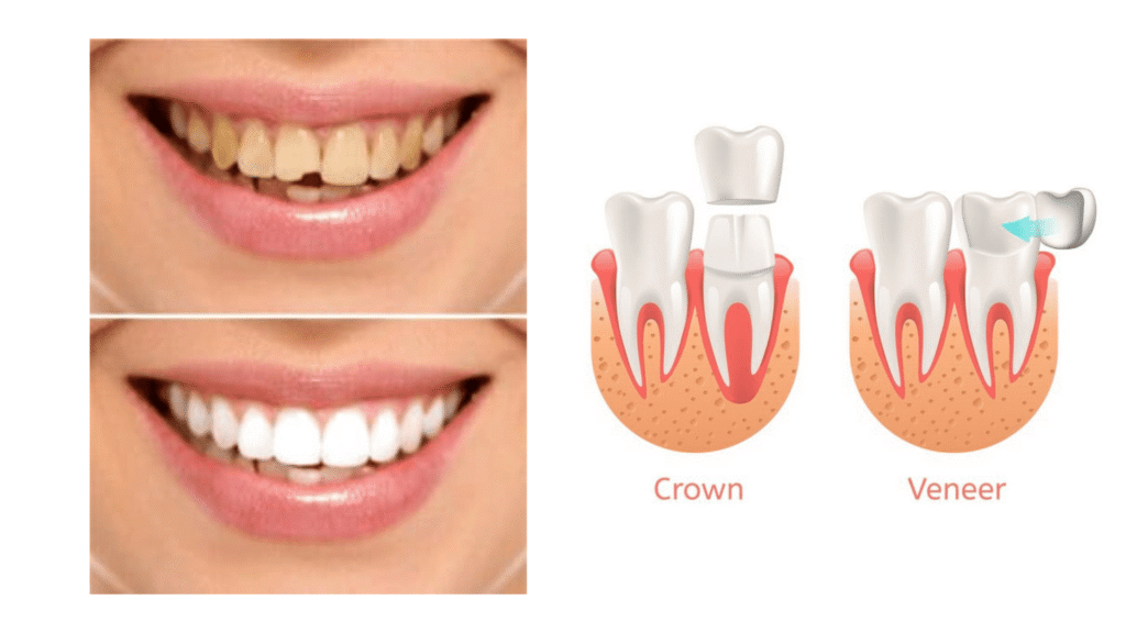 crown veneer