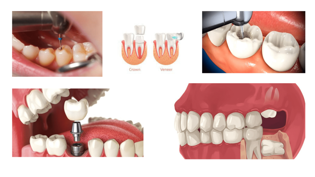Cavity Filling