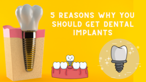 Dental Implants