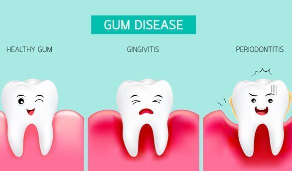 Periodontal Treatment