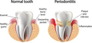 Signs and Symptoms of Periodontal Disease