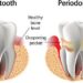 Signs and Symptoms of Periodontal Disease