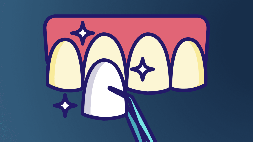What dental veneers are and how they're used to improve smiles