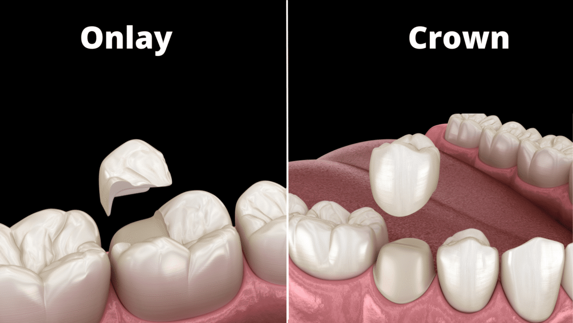 What’s the Difference between Onlay and Crown