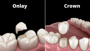 What’s the Difference between Onlay and Crown