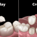 What’s the Difference between Onlay and Crown