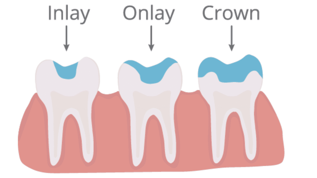 What’s the Difference between Onlay and Crown