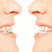 Straight Teeth Aren't Just For A Pretty Smile: Braces' Medical Benefits And How They Can Help You
