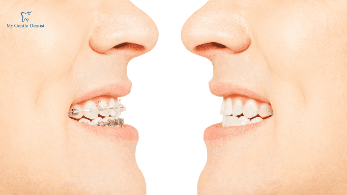 Straight Teeth Aren't Just For A Pretty Smile: Braces' Medical Benefits And How They Can Help You