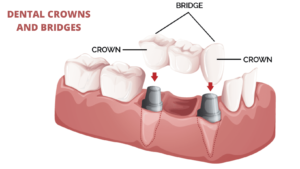 What are Dental Crowns and Bridges? Everything You Need to Know About Them