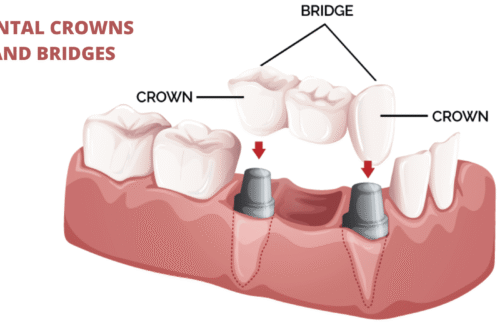 What are Dental Crowns and Bridges? Everything You Need to Know About Them