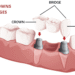 What are Dental Crowns and Bridges? Everything You Need to Know About Them