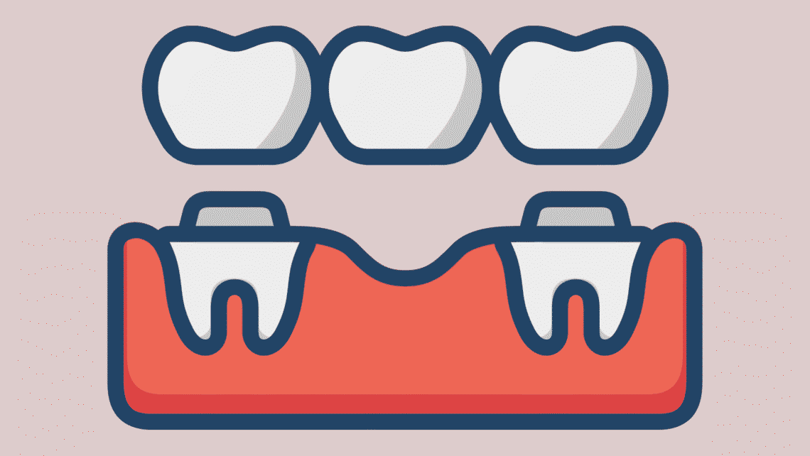 Dental Bridges