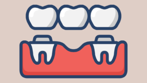 Dental Bridges