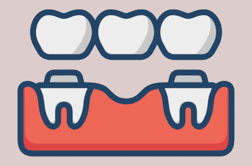 Dental Bridges