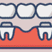 Dental Bridges