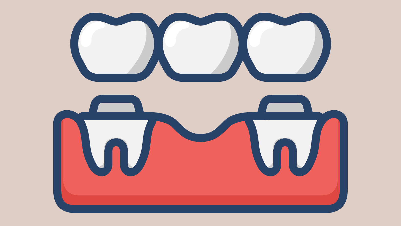 Dental Bridges