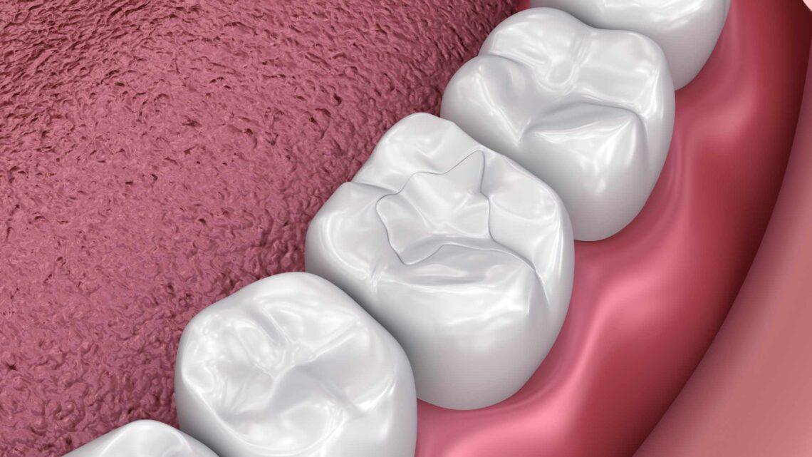 Dental filling