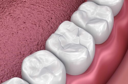 Dental filling