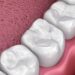 Dental filling
