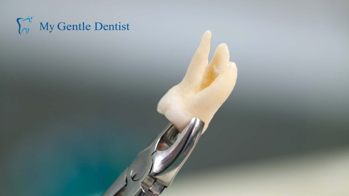 Wisdom Tooth Extraction