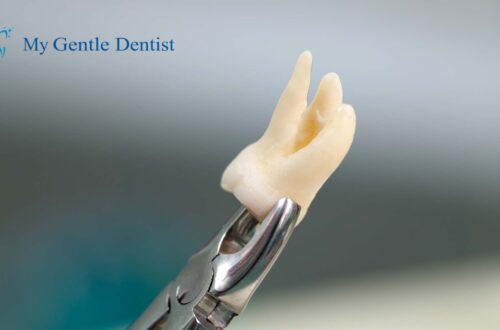 Wisdom Tooth Extraction