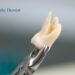 Wisdom Tooth Extraction
