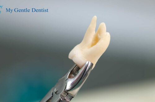 Wisdom Tooth Removal