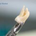 Wisdom Tooth Removal