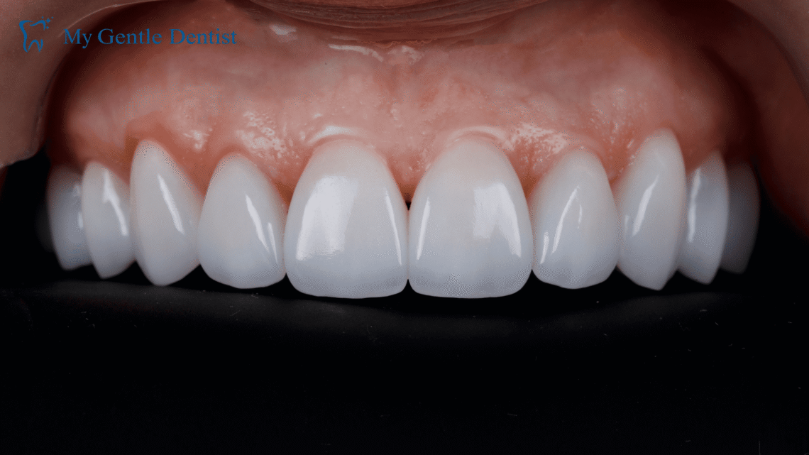 Dental veeners