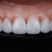 Dental veeners