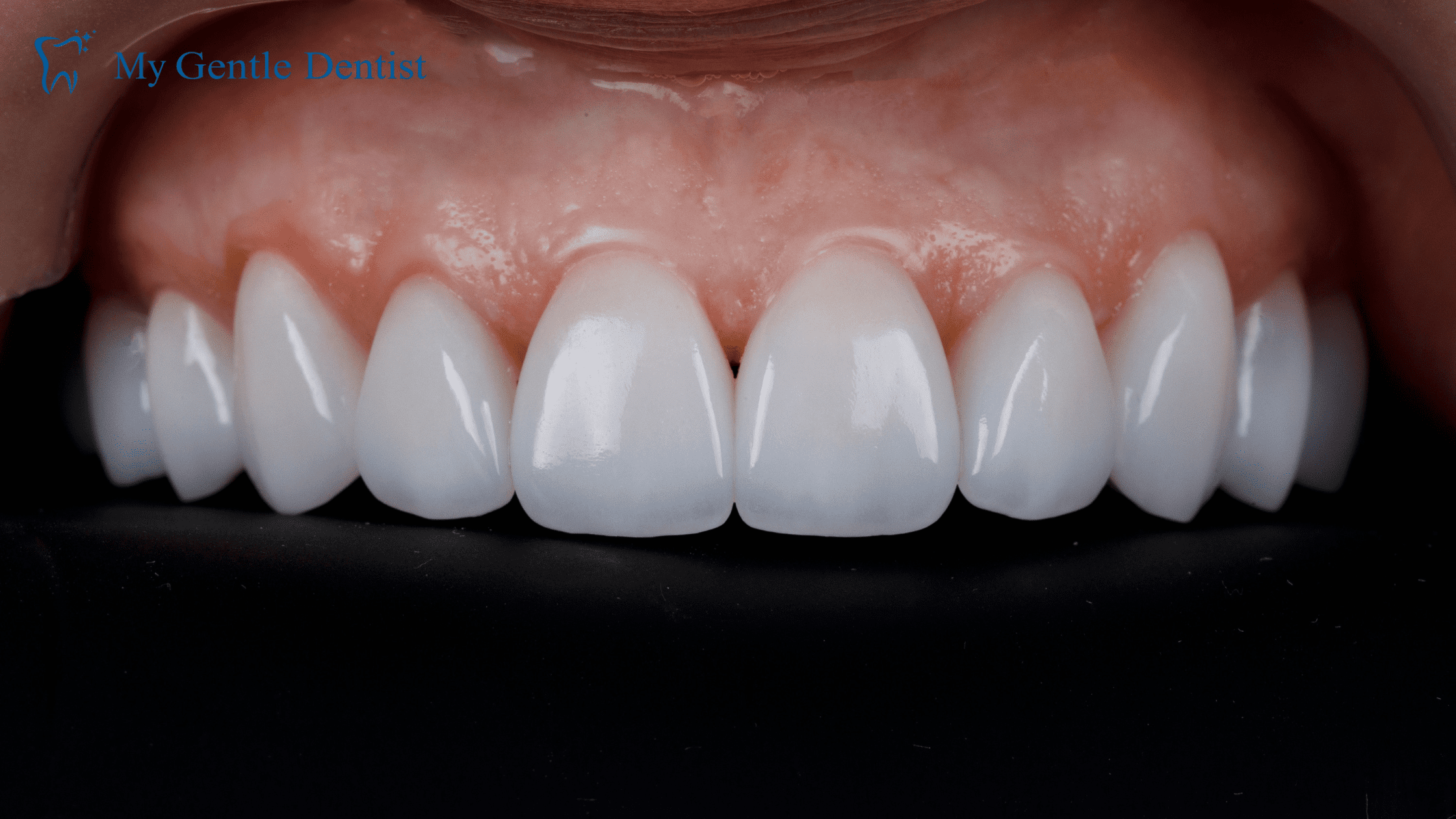 Dental veeners