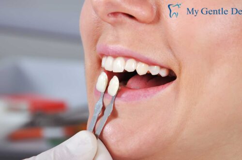 Porcelain Veneers